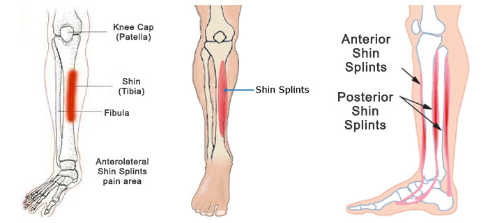 shin-splints-1